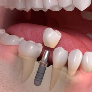 dental implants mountainview periodontics and dental implants periodontist dentist in glendale and parker colorado dr amy riffel and dr maryanne butler