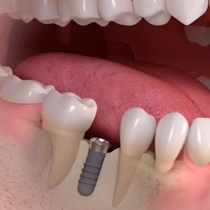 dental implants mountainview periodontics and dental implants periodontist dentist in glendale and parker colorado dr amy riffel and dr maryanne butler