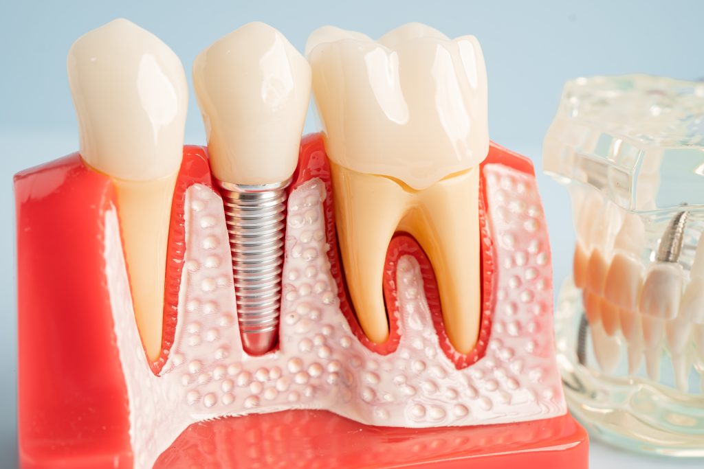 Dental Implants Parker and Glendale