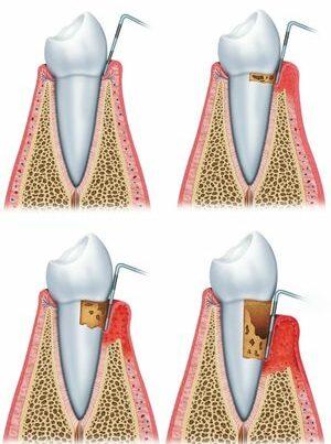 Illustration of gum flap treatment and cleaning around tooth roots