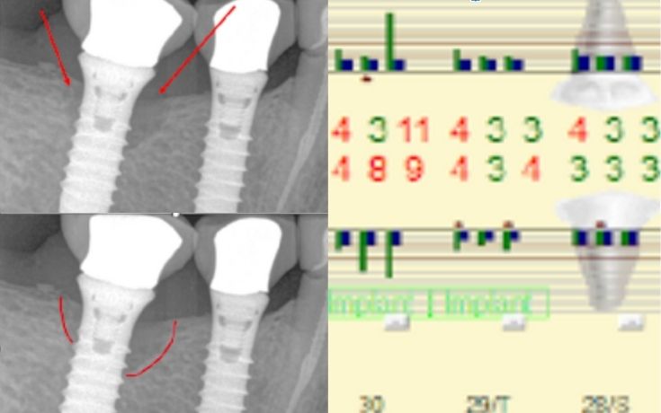 Before treatment for inflammation around a dental implant