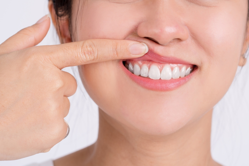 Woman pointing to her smile on the periodontal treatment article listing